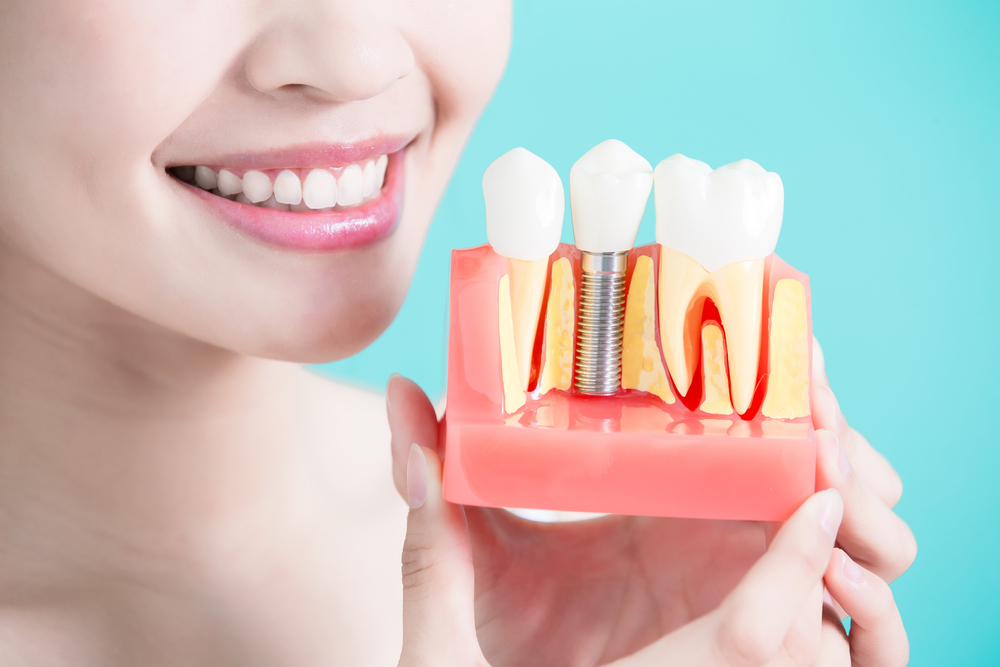 What are Dental Implants? A Complete Guideline